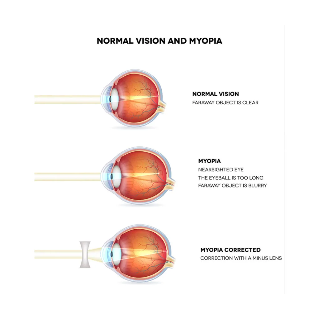 myopia management diagram